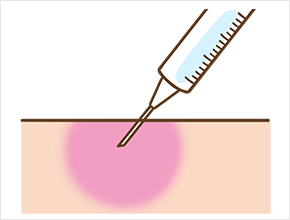 薬物の浸透圧による痛み