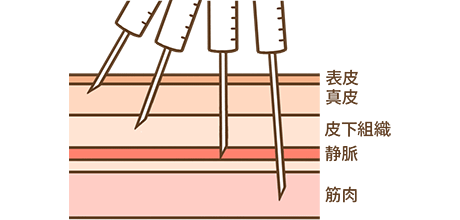 注射にはどんな種類があるの？