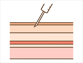 皮内注射